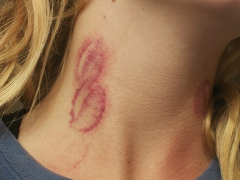 Red mark on neck looks like hickey