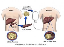 islet-cell-transplantation-